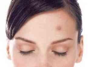 mujer-con-acne.jpg mujer con acne