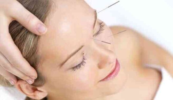 acupuntura