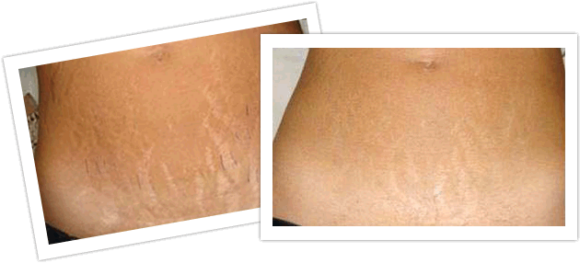 Mejorar la apariencia de las estrías 1 estrias