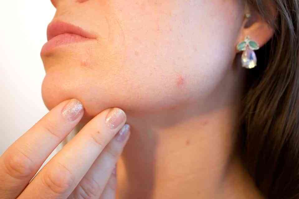 acne en la piel grasa